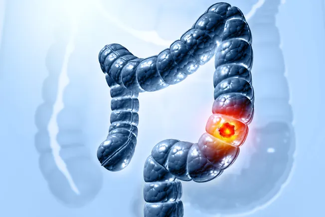 Freenome colorectal cancer test data improve on earlier results